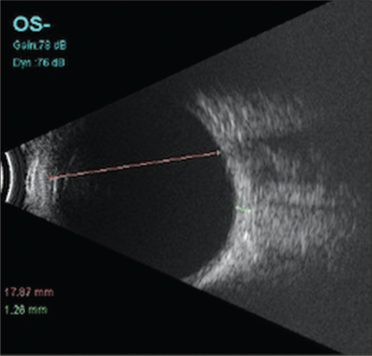 Ultrasound B-scan of a 6-month-old child showing anechoic vitreous cavity and axial length measurement (Pink line).