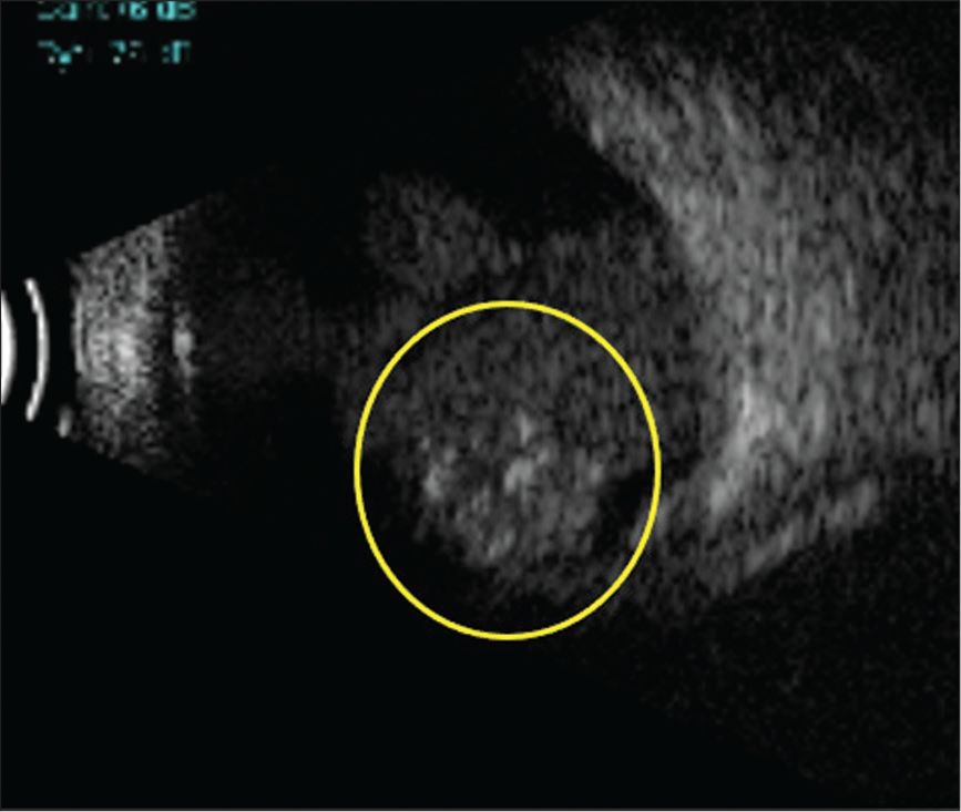 Ultrasound B-scan showing a heterogeneous retinal lesion with calcifications and high reflective echoes in the vitreous suggestive of retinoblastoma (yellow circle).