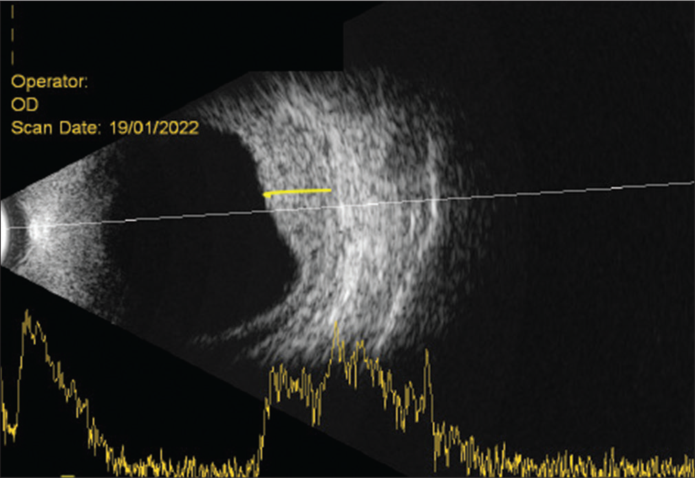 Ultrasound B-scan in a patient with Sturge-Weber syndrome with an underlying choroidal hemangioma in the form of increased choroidal thickness (yellow line).