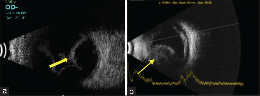 (a) Ultrasound B-scan showing smooth and dome like elevations not extending beyond the equator with echoluscent space behind the membrane in serous choroidal detachment (yellow arrow). (b) Multiple moderate-to-high reflective dot like echoes are seen in hemorrhagic choroidal detachment (yellow arrow).