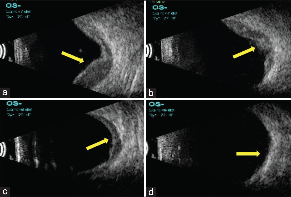 (a-d) Series of ultrasound B-scan pictures showing change in the contour of the choroidal detachment from convex to concave indicating that the hemorrhage or the detachment is resolving (yellow arrows).