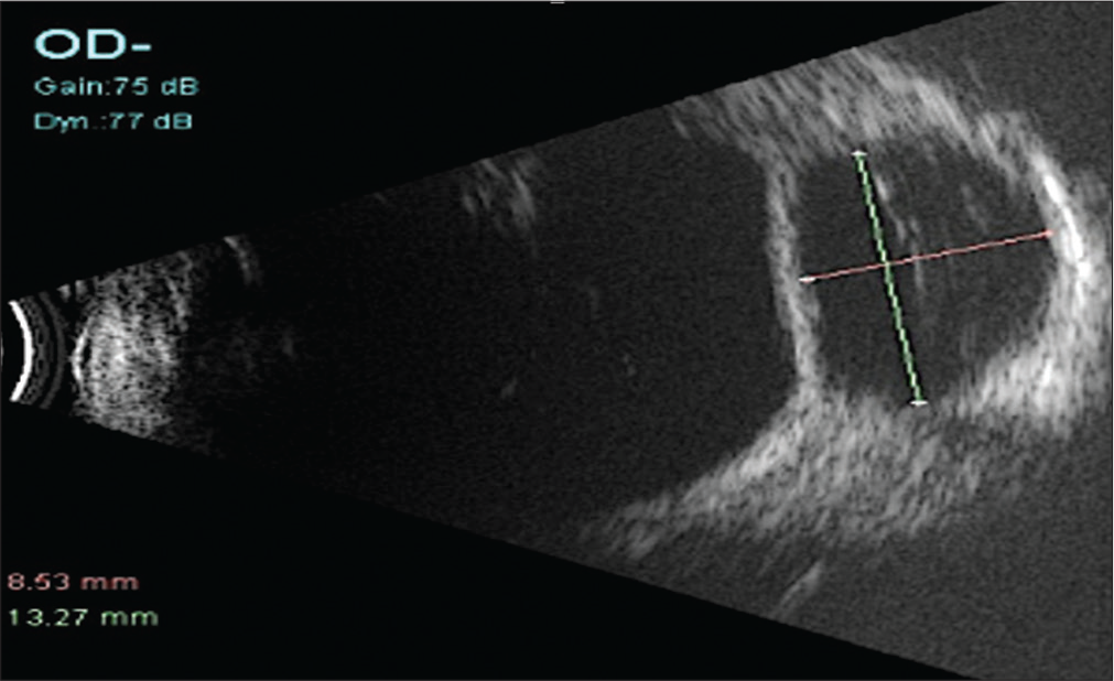 Echoluscent area surrounding the plate which is an echogenic structure indicating the fluid around the implant within the bleb along with the horizontal and vertical measurements (green and pink lines) of the bleb on B-scan ultrasound.