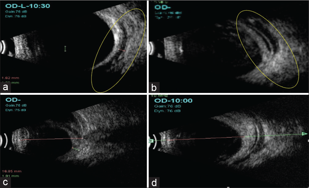 (a) Ultrasound B-scan showing a hypoechoic bleb devoid of any fluid (yellow circle) seen at 1-week post-operative visit off AADI implantation. (b) Ultrasound B-scan showing a large echoluscent fluid filled reservoir with the central hyperechogenicity (yellow circle) \indicating implant surrounded by fluid reservoir was noted confirming that the ligature has opened up at week 6 post-operative visit. (c) At 2-month post-operative visit, B-scan ultrasonography revealed kissing choroidal detachment. (d) Post-tube ligature B-scan revealed that choroidal detachment was resolved and fluid around the implant was noted.