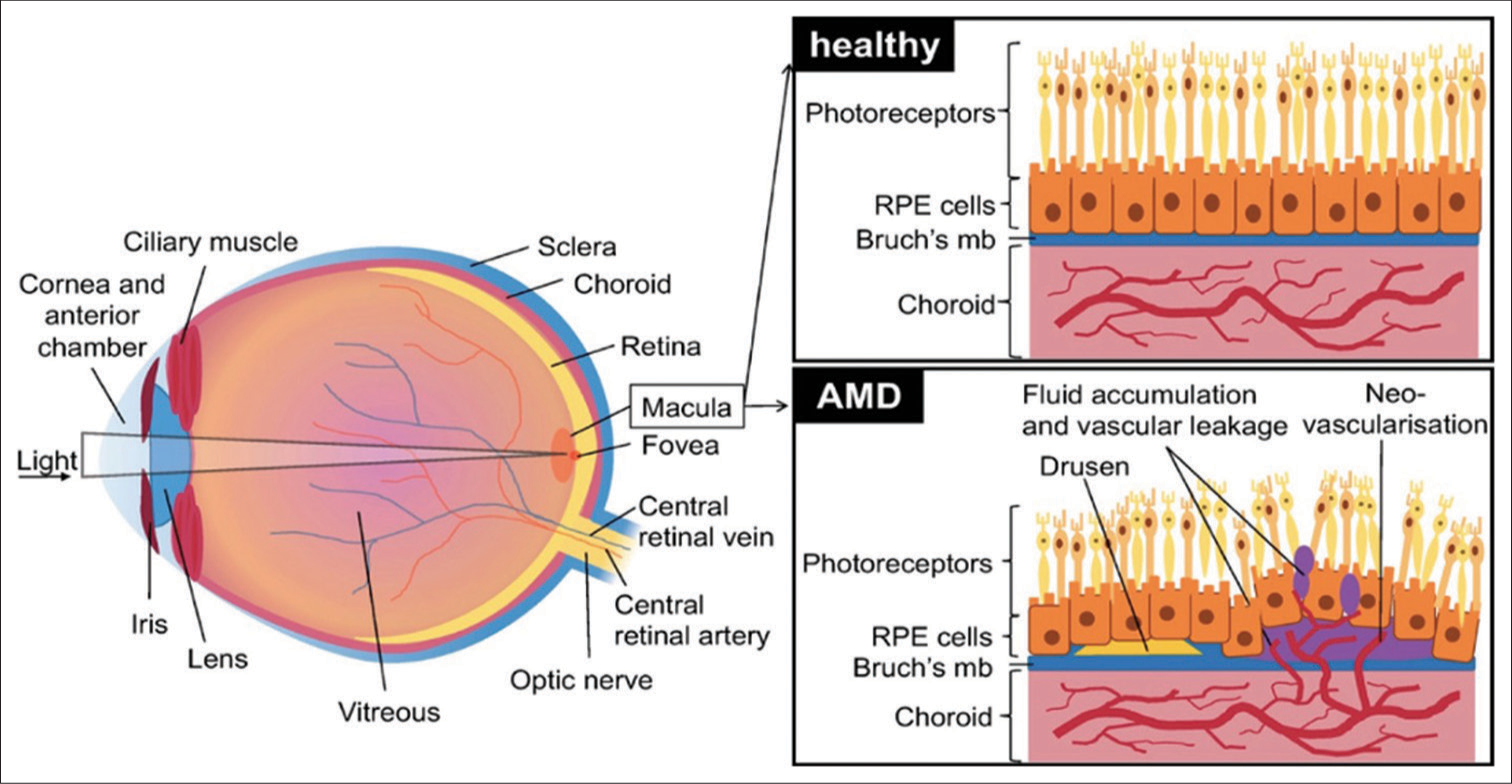 Schematic of the eye showing healthy retinal pigment epithelium and changes in age-related macular degeneration. RPE: Retinal pigment epithelium, AMD: Age-related macular degeneration.