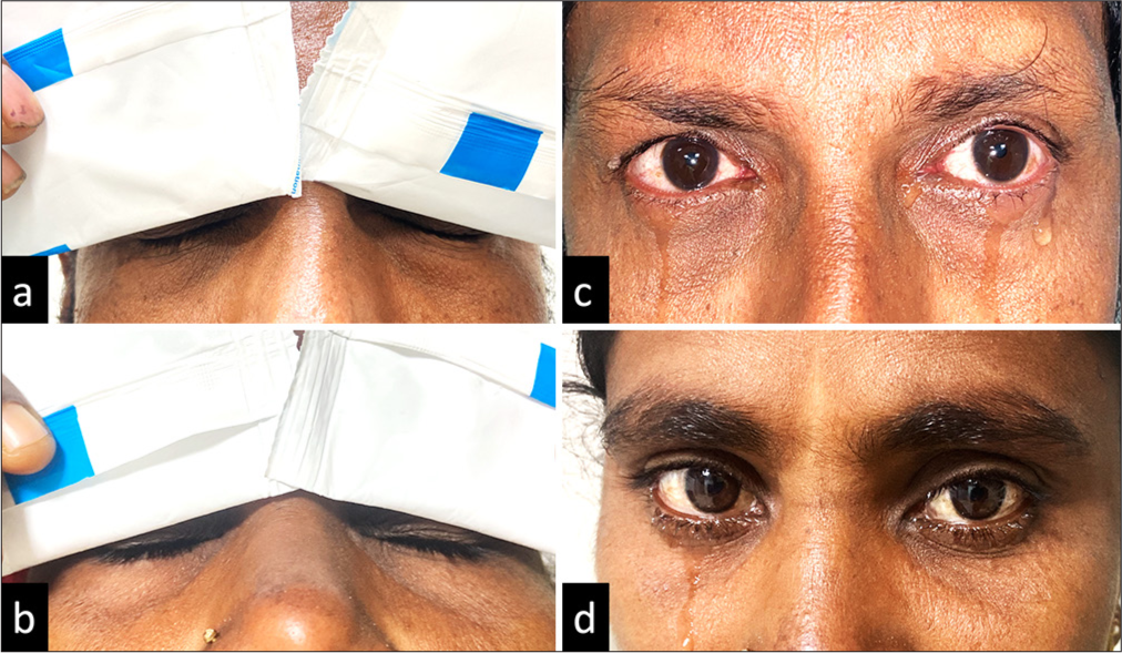 (a-d) (a and b) The application of gel ice packs at the closed eyelid in non-Sjögren’s dry eye patients. (c and d) The reflex lacrimation induced by the gel ice pack application, which was measured immediately using standard Schirmer strip.