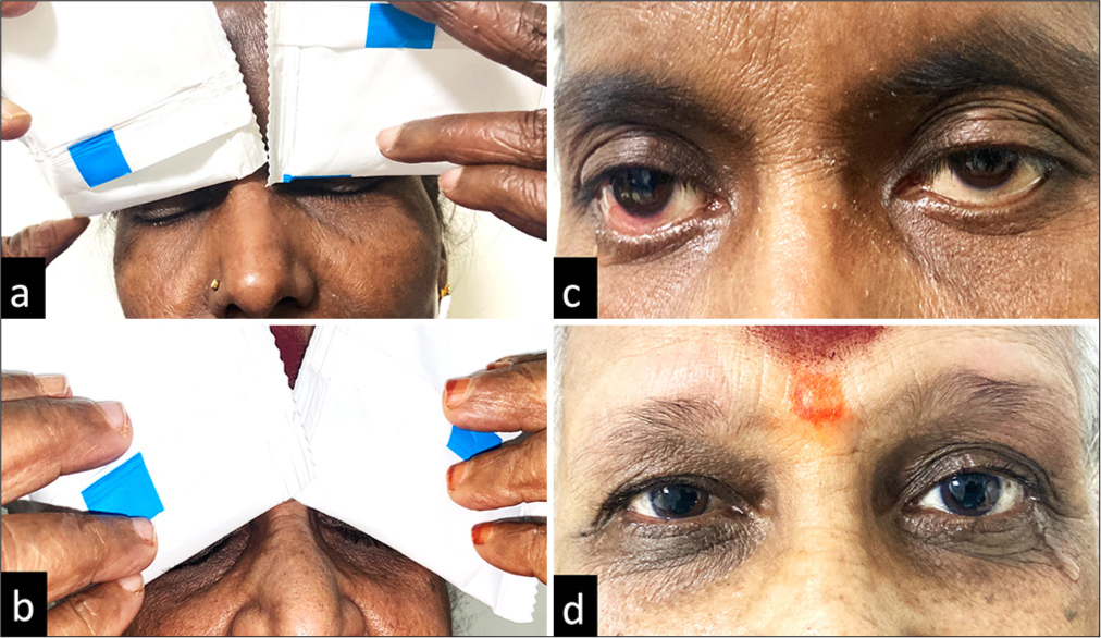 (a-d) (a and b) The application of gel ice packs at the closed eyelid in aqueous deficient Sjögren’s patients. (c and d) The reflex lacrimation induced by the gel ice pack application, which was measured immediately using standard Schirmer strip.